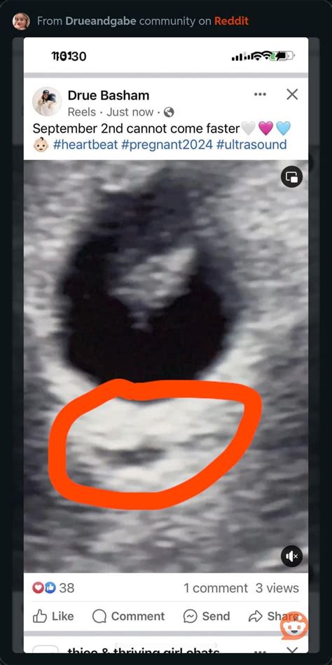 So someone from the ultrasound place she went to also leaked